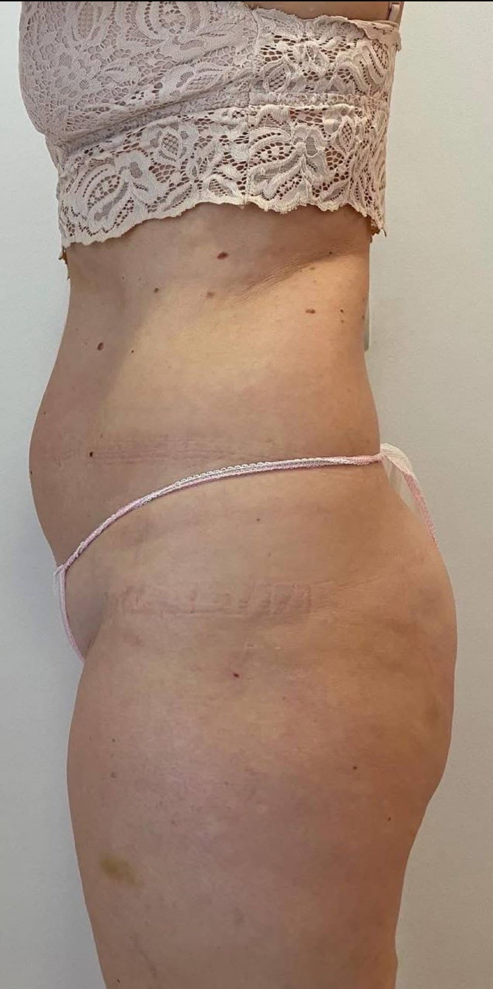 Abdomen y cintura de perfil antes y después de un protocolo corporal en Jade Esthétique Barcelona — Antes