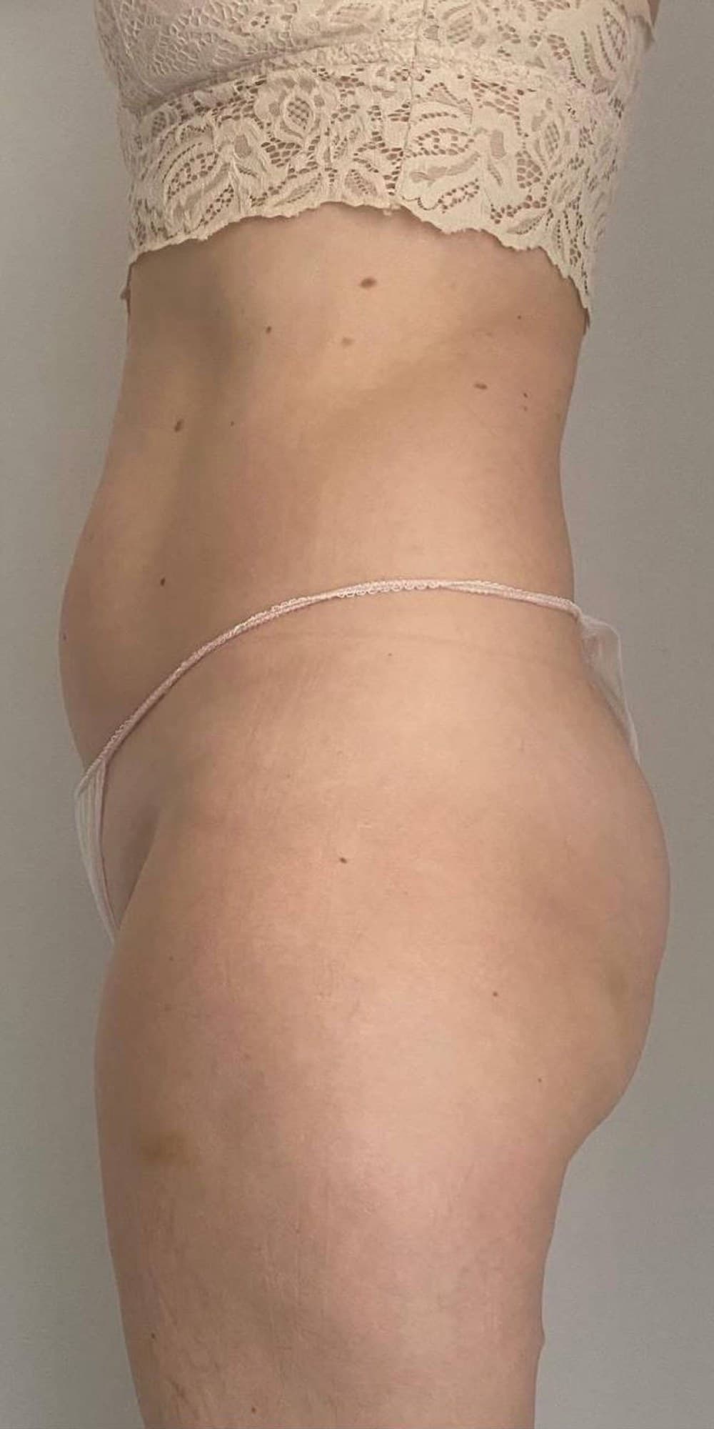Abdomen y cintura de perfil antes y después de un protocolo corporal en Jade Esthétique Barcelona — Después