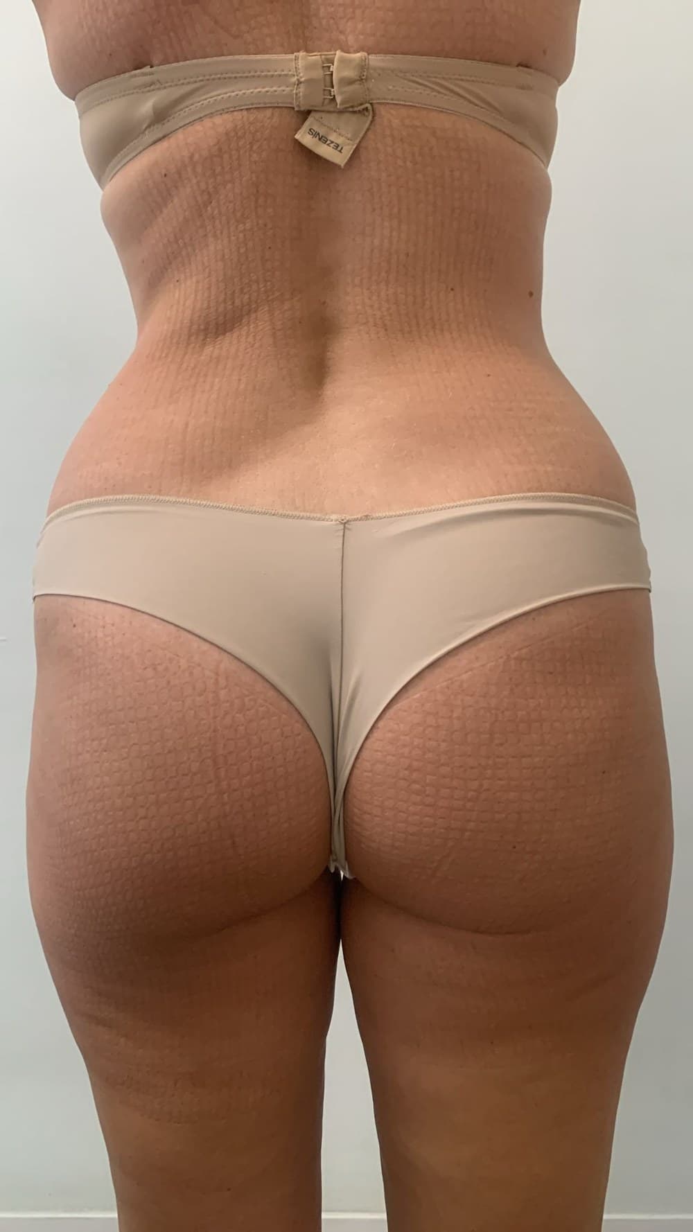 Cintura, espalda y piernas antes y después de un protocolo corporal en Jade Esthétique Barcelona: la silueta se redefine