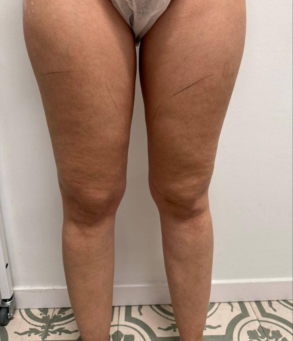 Muslos y rodillas antes y después de un protocolo corporal en Jade Esthétique Barcelona — Antes