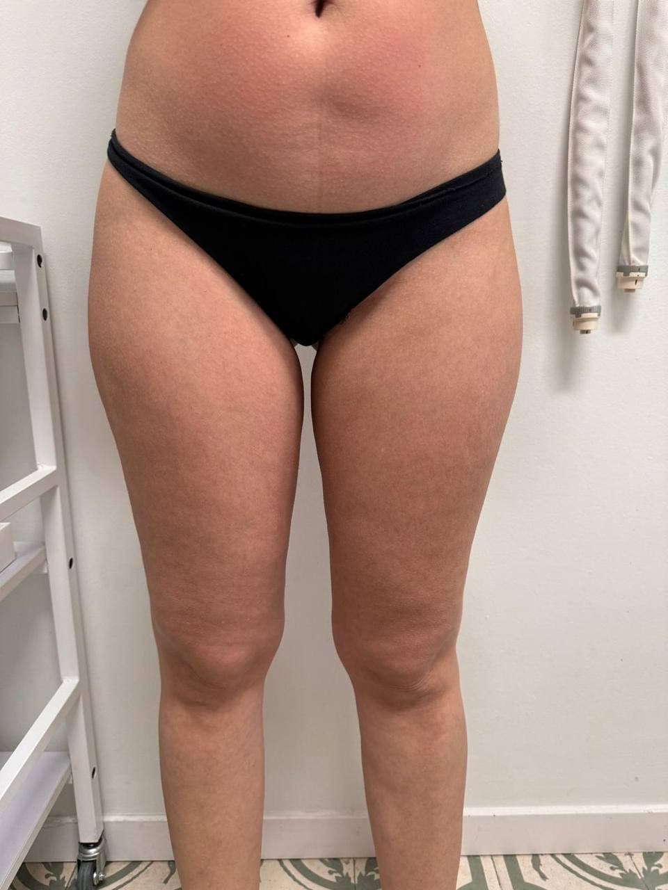 Muslos y rodillas antes y después de un protocolo corporal en Jade Esthétique Barcelona — Después