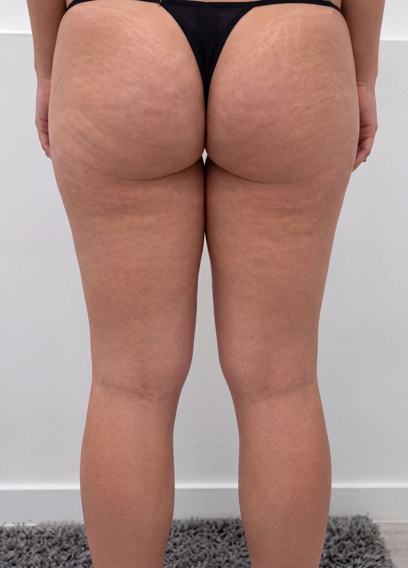 Piernas y glúteos antes y después de un protocolo corporal en Jade Esthétique Barcelona — Antes
