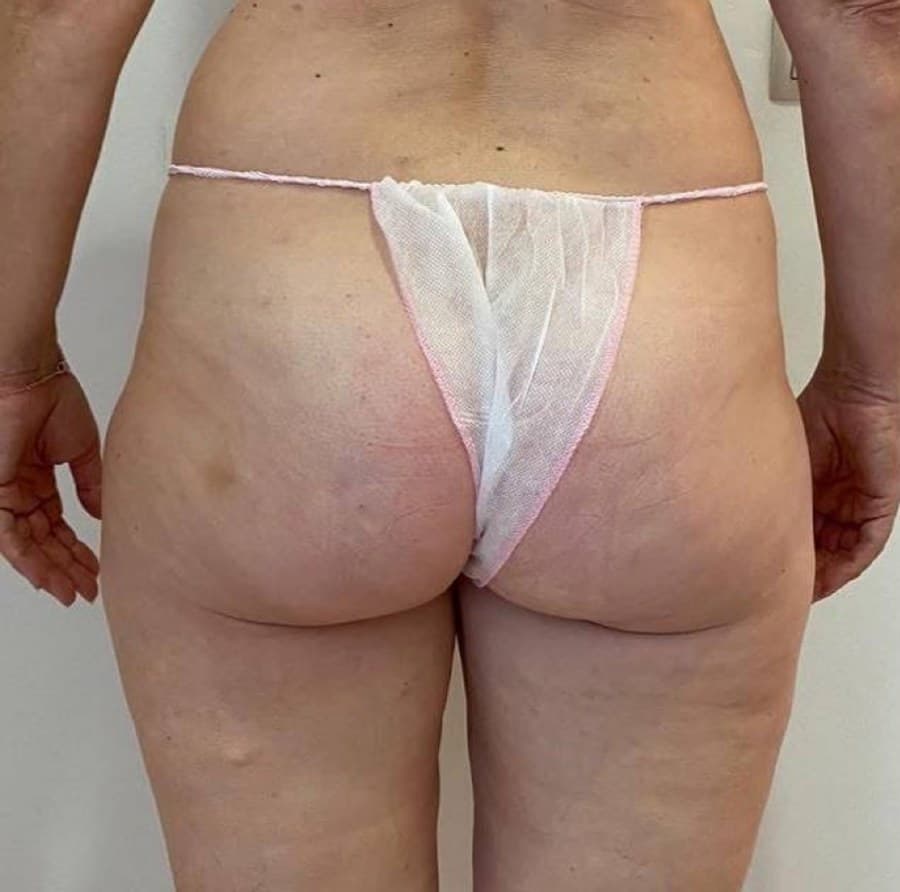 Glúteos por detrás antes y después de un protocolo corporal en Jade Esthétique Barcelona — Antes