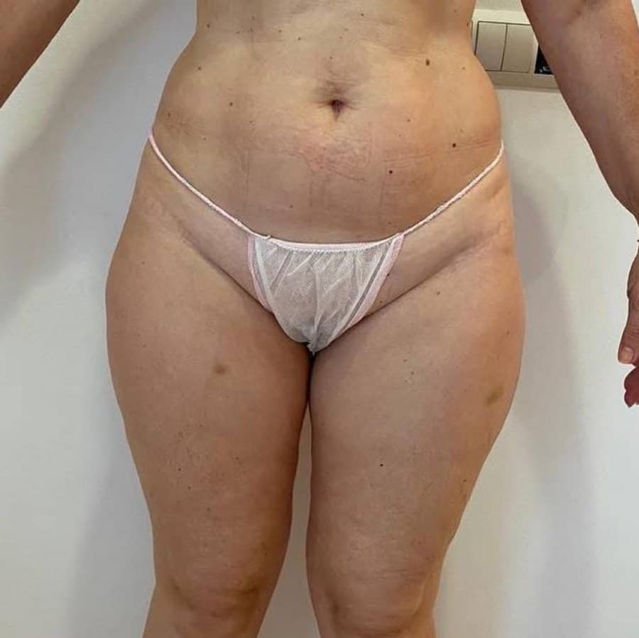 Piernas de frente antes y después de un protocolo corporal en Jade Esthétique Barcelona — Antes
