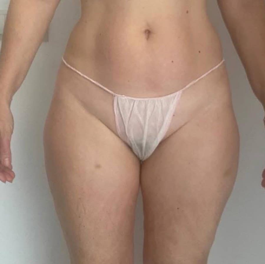 Piernas de frente antes y después de un protocolo corporal en Jade Esthétique Barcelona — Después